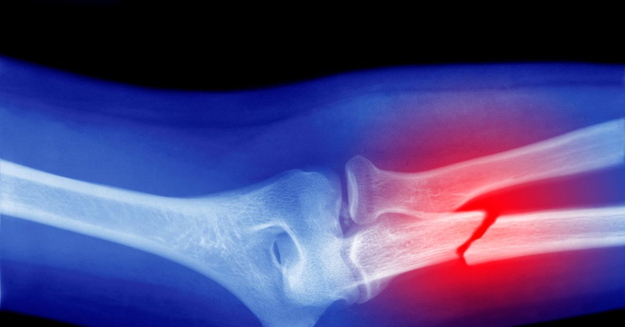 Microplasticity could weaken your bones, suggests a survey